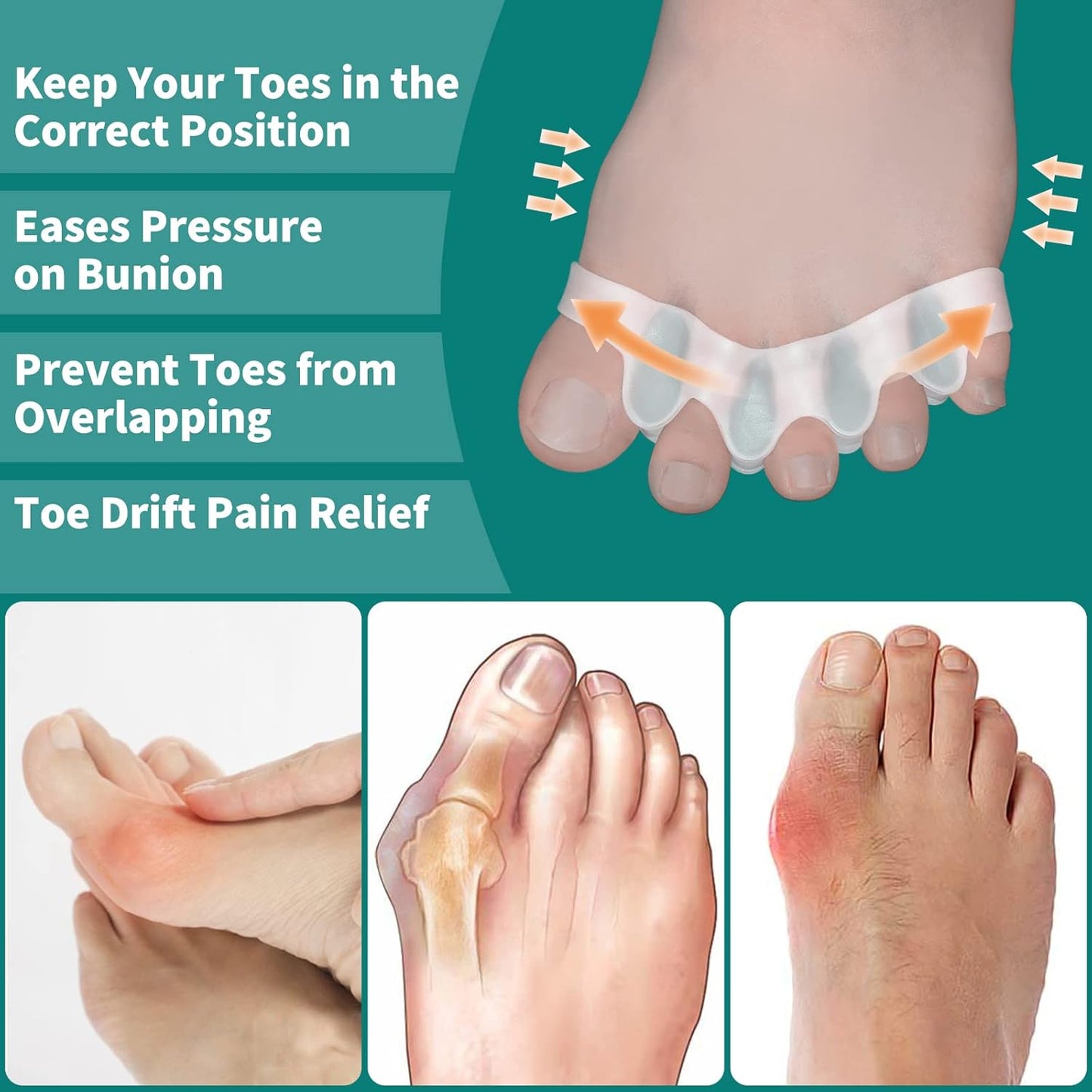 مصحّح أصابع القدم السيليكوني لتخفيف آلام إبهام القدم